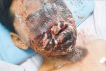 Trẻ 13 tuổi bỏng nặng vùng mặt, nguy cơ mất thị lực vĩnh viễn do pháo nổ