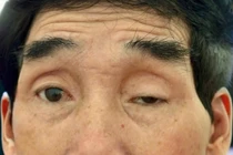 Giải phóng mí mắt sụp cho người đàn ông 65 năm 'nhìn đời qua khe cửa hẹp'