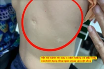 Nội soi lồng ngực cải tiến cứu bé sơ sinh 2 ngày tuổi