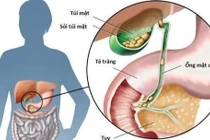 Phẫu thuật lấy gần 300 viên sỏi túi mật cho người phụ nữ 61 tuổi