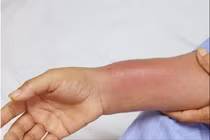 Người phụ nữ nhiễm trùng nặng sau khi cấy chỉ giảm đau xương khớp