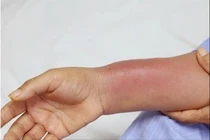 Người phụ nữ nhiễm trùng nặng sau khi cấy chỉ giảm đau xương khớp