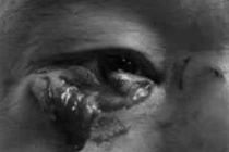 Người đàn ông 42 tuổi bị chó nhà cắn rách mi mắt