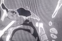 Lấy mũi khoan cắm sâu trong hốc mũi nam thanh niên ở Thanh Hóa