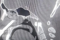 Lấy mũi khoan cắm sâu trong hốc mũi nam thanh niên ở Thanh Hóa