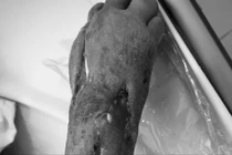 Hành trình cứu sống bệnh nhân người Mông mắc nhiều bệnh nguy hiểm