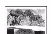 Bóc tách khối u xơ 'khủng', giữ lại tử cung cho người phụ nữ 34 tuổi