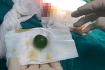 Cứu bé 13 tuổi nuốt phải viên hạt nở lớn tại Lào Cai