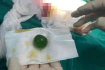 Cứu bé 13 tuổi nuốt phải viên hạt nở lớn tại Lào Cai