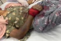 Người phụ nữ ở Lâm Đồng bị rắn cắn nguy kịch tính mạng