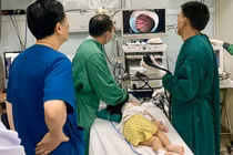 Gắp dị vật kẹp tóc dài 5cm trong dạ dày bé gái 21 tháng tuổi