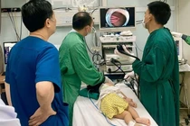 Gắp dị vật kẹp tóc dài 5cm trong dạ dày bé gái 21 tháng tuổi