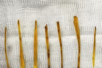 Nuốt xương gà gây thủng ruột, bé gái 13 tuổi cần phẫu thuật khẩn cấp