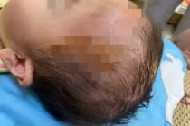 Bé gái 19 tháng tuổi bị chó cắn phải nhập viện 