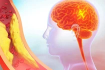 Hẹp động mạch cảnh, căn bệnh nguy hiểm khó nhận biết