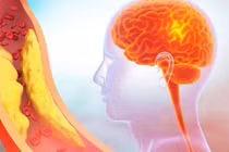 Hẹp động mạch cảnh, căn bệnh nguy hiểm khó nhận biết