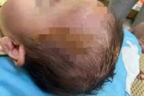 Bé gái 19 tháng tuổi bị chó cắn phải nhập viện 