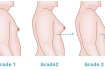 50 - 70% nam giới có dấu hiệu vú to, chớ nên chủ quan