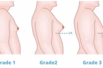 50 - 70% nam giới có dấu hiệu vú to, chớ nên chủ quan