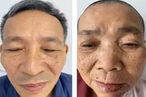 Liệt mặt do zona - hiểm họa khôn lường có thể phát hiện sớm