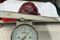 Cắt gan 2 giai đoạn cho người bệnh 48 tuổi bị u gan khổng lồ