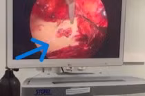 Đau bụng, tiểu đục do sỏi niệu quản 2 cm án ngữ đài bể thận