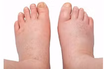 Nhận biết sớm nguy cơ suy thận qua dấu hiệu đi lại, phù chân