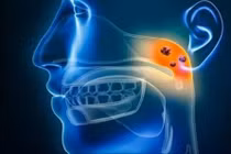 Nguyên nhân âm thầm dẫn đến ung thư vòm họng, cách phòng tránh