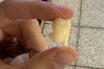 Răng khôn có nhất thiết phải nhổ không?