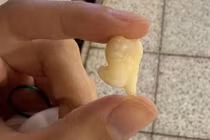 Răng khôn có nhất thiết phải nhổ không?