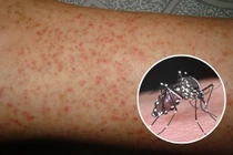 Cảnh báo sốt xuất huyết lan rộng, cần hành động từ mỗi hộ gia đình