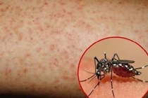 Khánh Hòa ghi nhận số ca sốt xuất huyết tăng mạnh