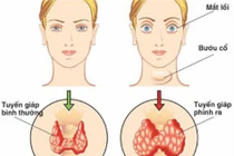 Ngừng thuốc kháng giáp có tái phát bệnh Basedow?