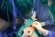 Cẩn thận u nang bì mắt gây biến dạng xương, ảnh hưởng thị lực