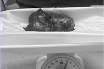 Bóc khối u khổng lồ cho người đàn ông Campuchia