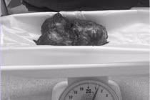 Bóc khối u khổng lồ cho người đàn ông Campuchia