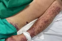 Hà Nội ghi nhận ca tử vong đầu tiên do liên cầu khuẩn lợn năm 2025