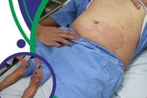 Ăn cơm với cá thu, người đàn ông 32 tuổi sốc phản vệ