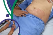 Ăn cơm với cá thu, người đàn ông 32 tuổi sốc phản vệ