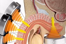 Sóng xung kích điều trị rối loạn cương dương