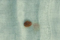 Bé 9 tuổi đau quặn thận do sỏi niệu quản, khuyến cáo khi trẻ đau bụng