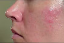 Viêm da tiết bã dễ tái phát, kéo dài dai dẳng nếu không điều trị đúng cách
