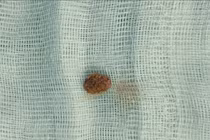 Bé 9 tuổi đau quặn thận do sỏi niệu quản, khuyến cáo khi trẻ đau bụng