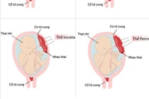 Bảo tồn tử cung cho sản phụ mắc rau cài răng lược đe dọa tính mạng