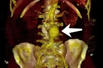 Đau bụng, nhiều người nguy kịch vì vỡ phình động mạch chủ
