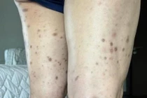 Sống chung với nốt sẩn ngứa 10 năm, không ngờ bệnh hiếm ác tính