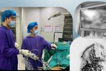 Chấn thương bụng kín dễ vỡ lách đe dọa tính mạng