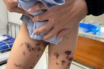 Bé trai Nghệ An bị bỏng nặng do nước tẩy bồn cầu bắn vào người