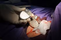 Chuyên gia chỉ cách sinh hoạt, vận động để khỏe mạnh sau đặt máy tạo nhịp