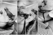 Trẻ 5 tuổi bị chó cắn chấn thương hàm mặt phức tạp